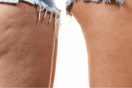 Kobieta z cellulitem i bez cellulitu